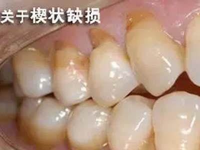 牙齿楔状缺损要怎么治疗?
