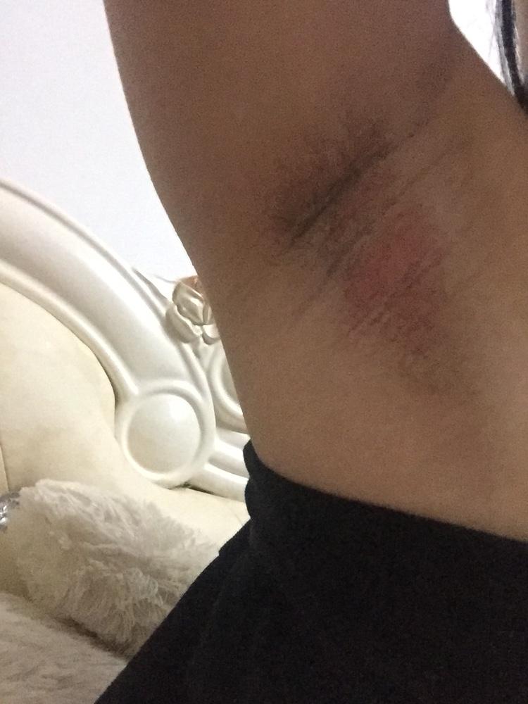 怀孕五个月腋下发红疼痛怎么回事,知道的告知一下
