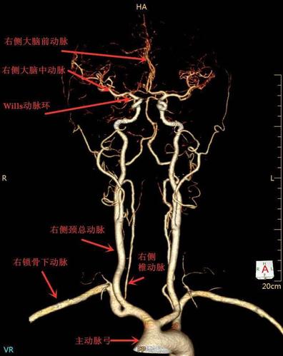 乌拉特前旗人民医院影像中心带你认识头颈部血管cta成像技术