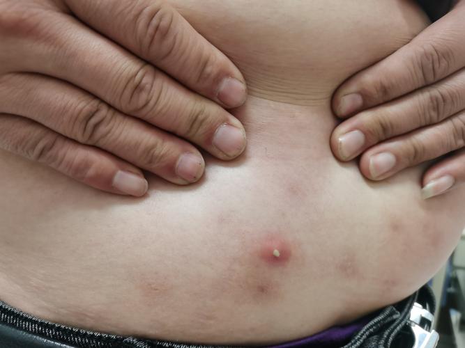 需警惕是白塞病 写美篇白塞病 (behet syndrome,bd)是一种以血管炎为