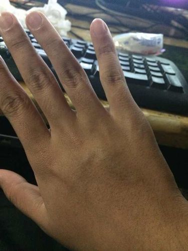 手掌内和手背长了血管瘤,还是别的