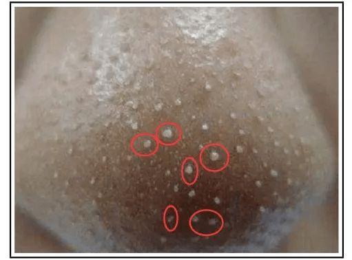 白头黑头全都浮了出来,@tete自己看着到要yue了前方恶心预警!