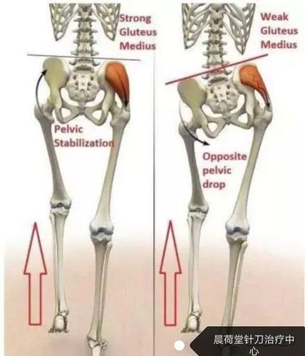 双下肢自然伸直略分开,放松双足,表现一侧外旋(称为阳脚),是髂骨后旋