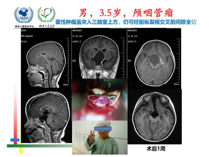 解剖课件 | 儿童鞍区肿瘤常见手术入路- 北京儿童医院