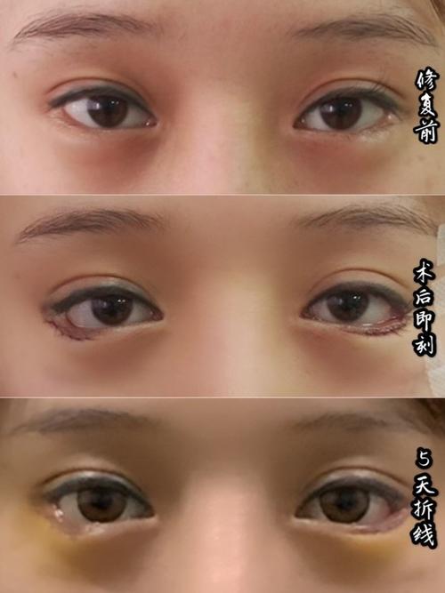开外眼角 下睑下至失败修复案例分享~外眼角与下睑下至开到多大是极限