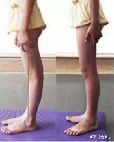 你是否膝盖超伸?