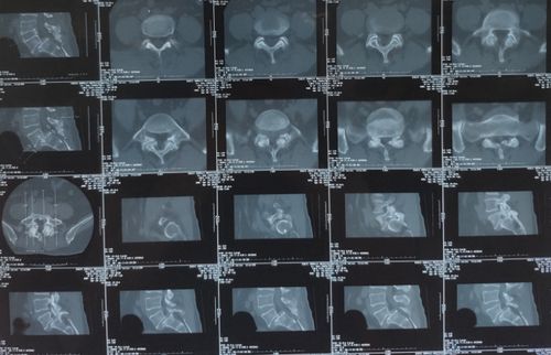 诊断:腰5椎体滑脱症(3度);腰5双侧椎弓峡部裂. vas评分:6分.