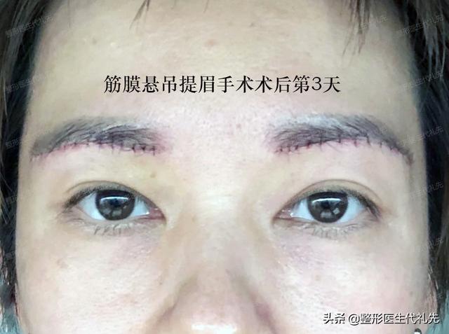 提眉手术需要多久恢复提眉手术多久可以见朋友见客户上班