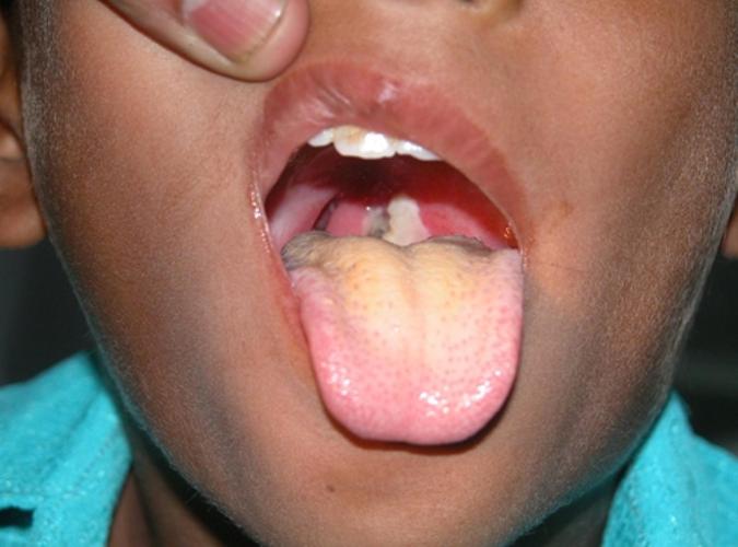 白喉病入侵langkawi!已证实有三名病患者!近期有去langkawi的注意了!