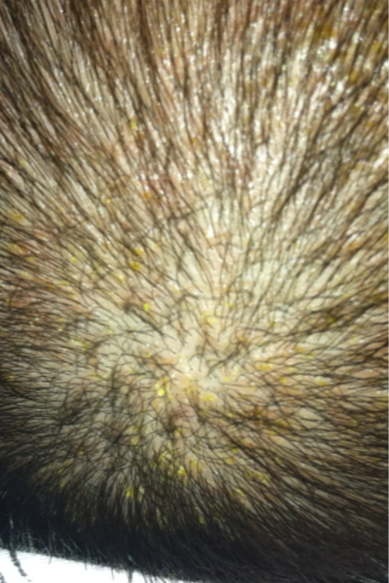 宝宝头顶长的黄色结痂是什么?急诊!