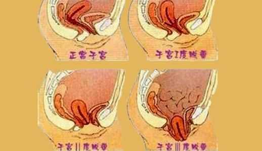 子宫脱垂的症状有哪些