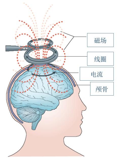 东北国际医院康复医学科成立经颅磁刺激治疗中心