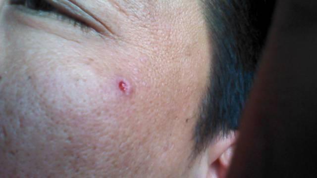 我的脸上前几天起了个血管瘤,,后来去医院做个治疗,好