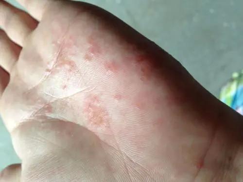 长春肤康医院浅谈:皮炎与湿疹之间到底有哪些区别?