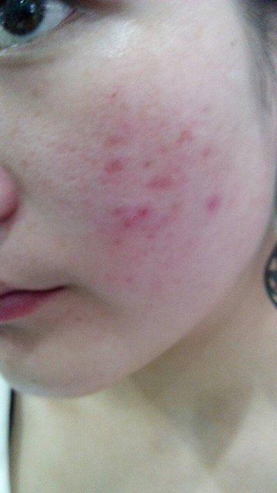 化妆品过敏症状