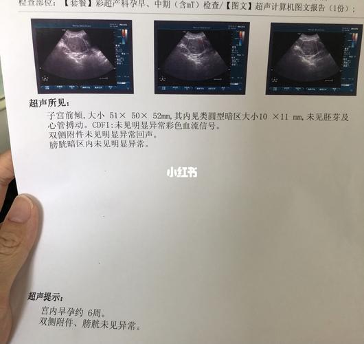 排卵第23天的孕囊_孕囊_中医_b超_早早孕_母婴_孕产