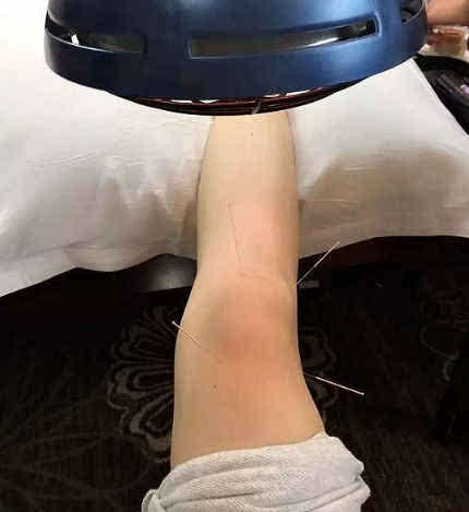 受伤接受针灸的照片,微笑自拍并调侃说道:"打戏后遗症,膝盖严重积水