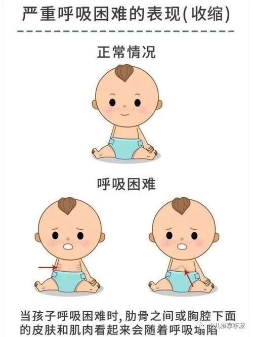 小儿推拿李波小儿急性喉炎不可轻视立即就诊严重可危及生命