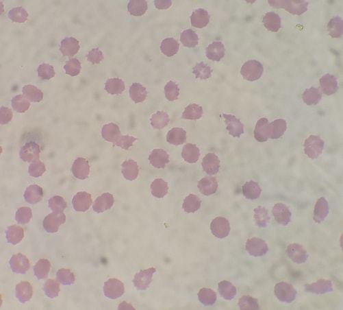 教科书都没这样写血小板假性升高竟是