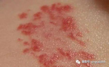 婴幼儿毛细血管瘤有哪些常见症状