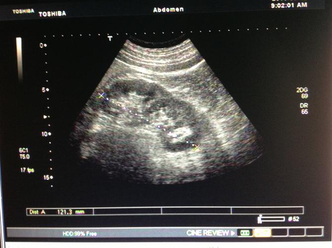 这样的肾脏图像怎么报 - 超声医学讨论版 - 爱爱医