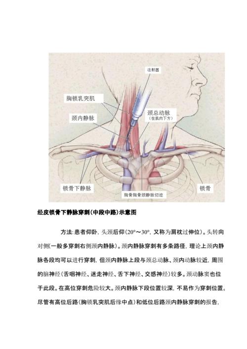 颈内静脉穿刺三指法定位模板.pdf
