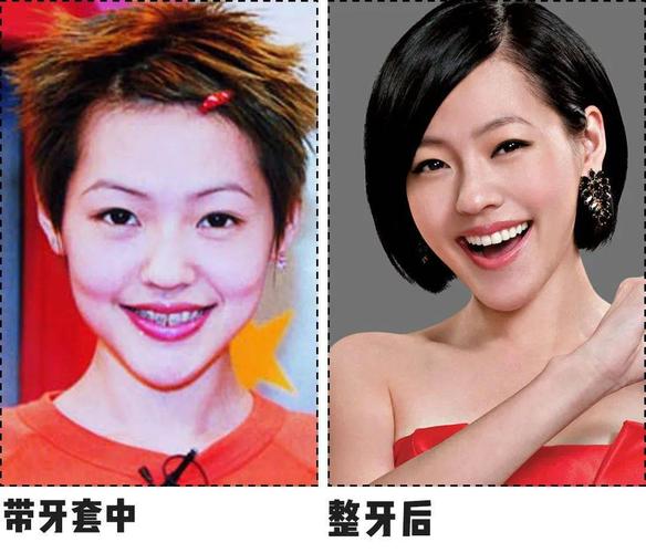 为了上镜笑起来更美,小s开始戴上牙套,还出了一本书叫做《牙套日记》