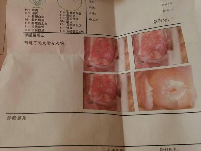 大家帮忙看看有没有宫颈糜烂跟宫颈炎,医生说宫颈都烂啦,吓死我啦!