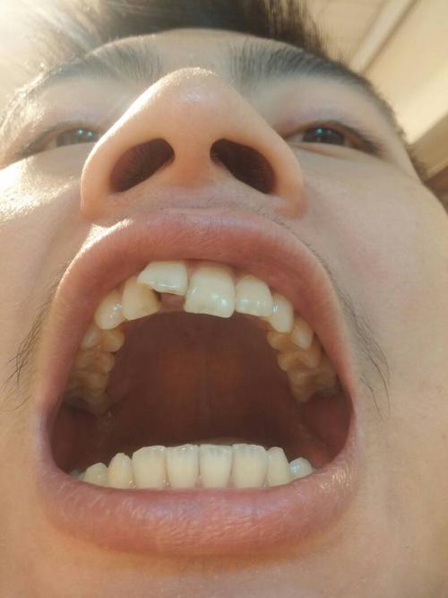 我今年22,门牙很难看,长歪了该怎么弄,有图片