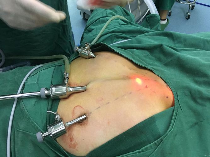 腔镜下甲状腺肿物切除术