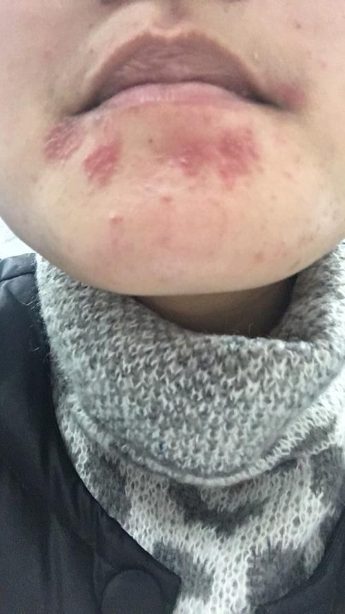 脸部红疹 是湿疹还是疱疹还是皮炎?