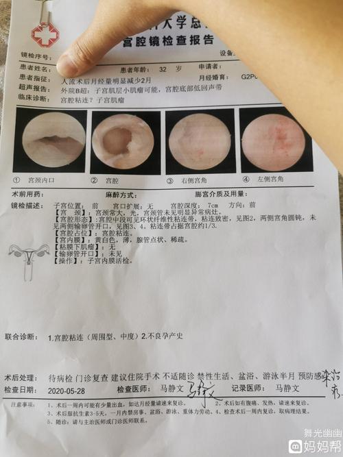 宫腔镜检查结果 宫腔粘连 中度 需要住院