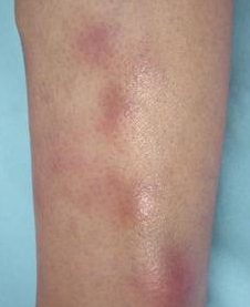 白塞病有误诊的么