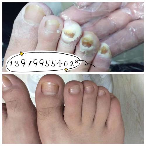 一人灰指甲,全家都害怕,甲冉生灰指甲(全国连锁芦溪店