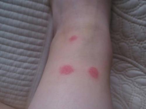 这个是被什么虫子咬的,肯定不是蚊子,有点肿还痒痒,昨天去姥姥家的