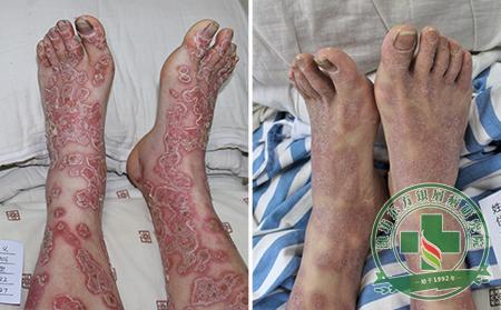 牛皮癣是怎么引起的?