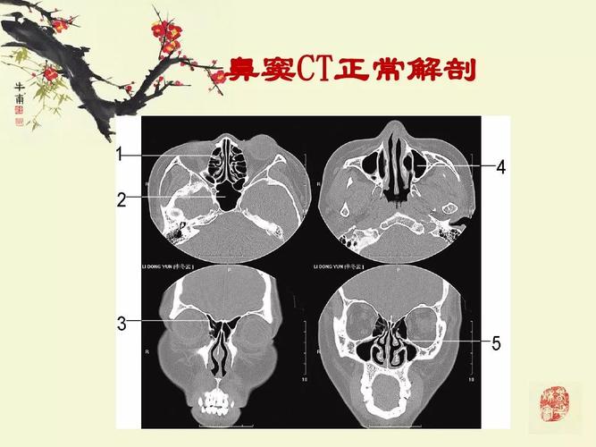 鼻,鼻窦炎的影像学表现