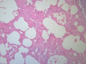 小叶性肺炎显微图片20张