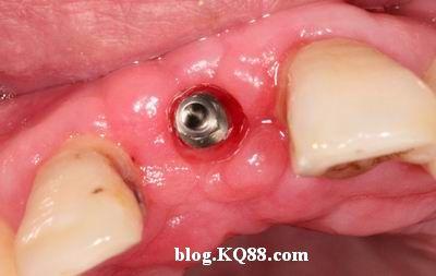 牙龈袖口形成良好