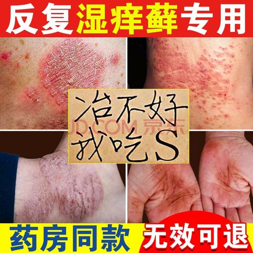 苗居堂万癣灵顽固慢性湿疹膏成人过敏荨麻肛门皮肤瘙痒阴囊潮湿疹立消