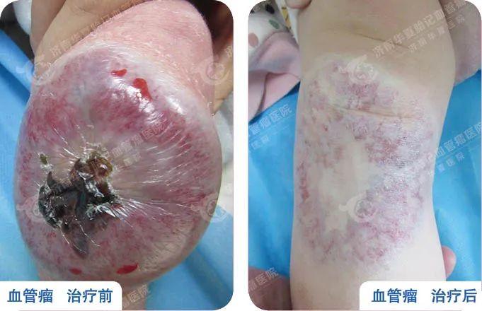 首先,患处要保持干燥,特别是婴幼儿草莓状毛细血管瘤,更要注意日常