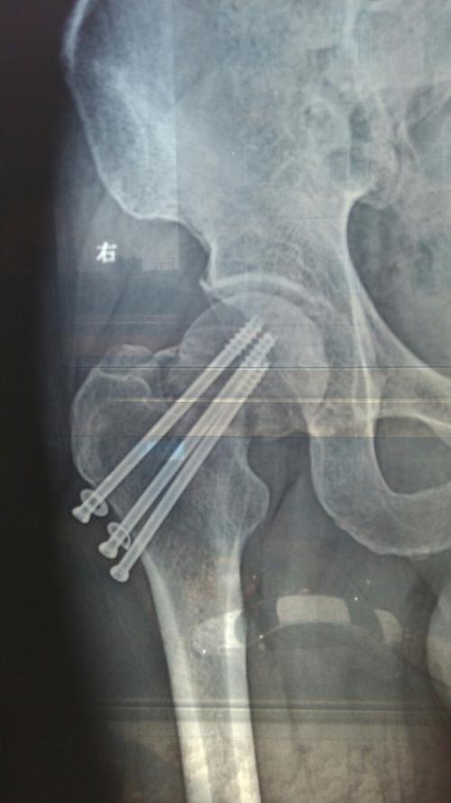 问题:股骨颈骨折术后情况