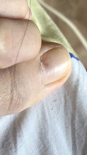 脚趾甲上有黑斑是怎么回事,是灰指甲么?