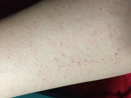 身上突然出现很多出血点是什么原因 勒过的地方出现大片出血点 血常规