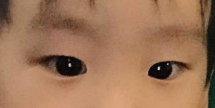 孩子突然斗鸡眼,只能手术吗?对话彭海鹰:打一针可以治疗