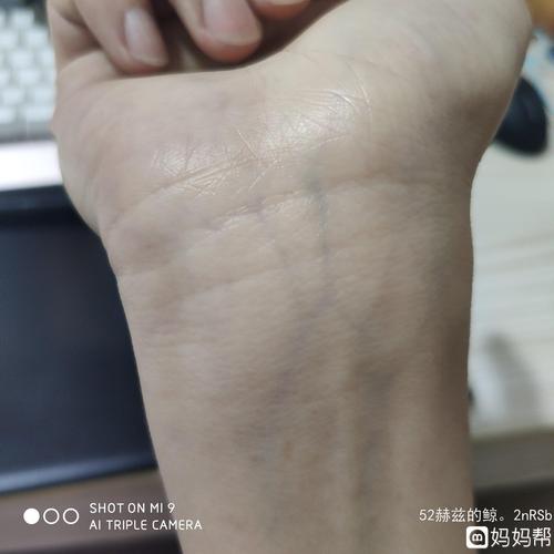 怀孕三个半月突然发现手上毛细血管特别明显