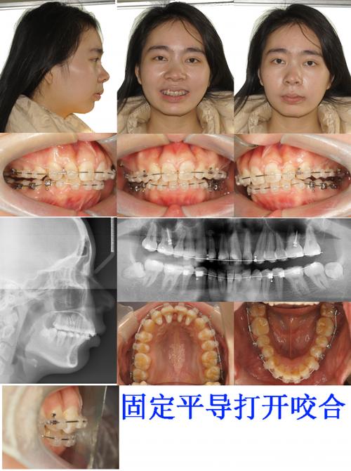 超级深覆合多牙正锁
