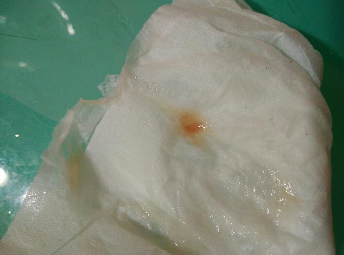 左侧鼻子每天早上鼻涕回吸有带血,,吃了很多药也没有好!