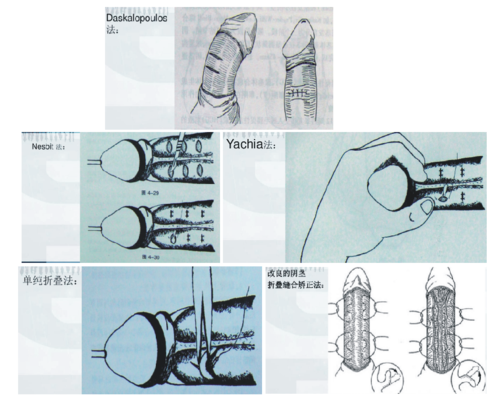 男性阴茎弯曲畸形及临床诊断治疗(精华帖)