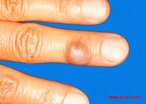 淋巴结结节病的其他病种